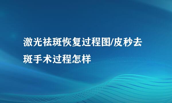 激光祛斑恢复过程图/皮秒去斑手术过程怎样