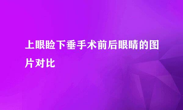 上眼睑下垂手术前后眼睛的图片对比