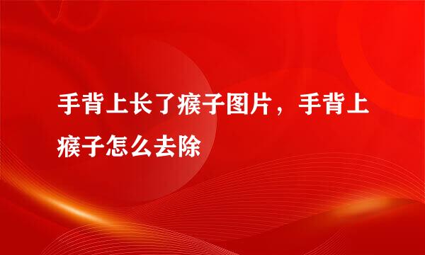 手背上长了瘊子图片，手背上瘊子怎么去除