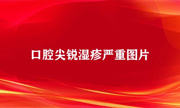 口腔尖锐湿疹严重图片
