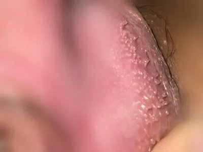 假性湿疣肉丁图片