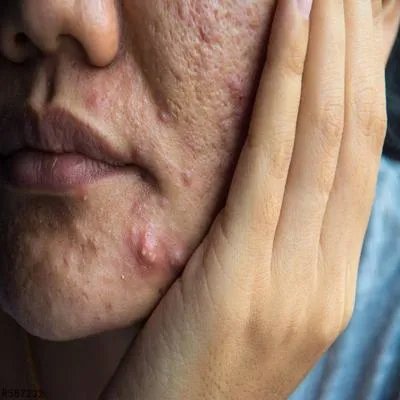 激素性皮炎的症状表现是什么