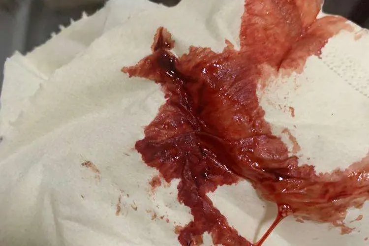 月经有拉丝血图片