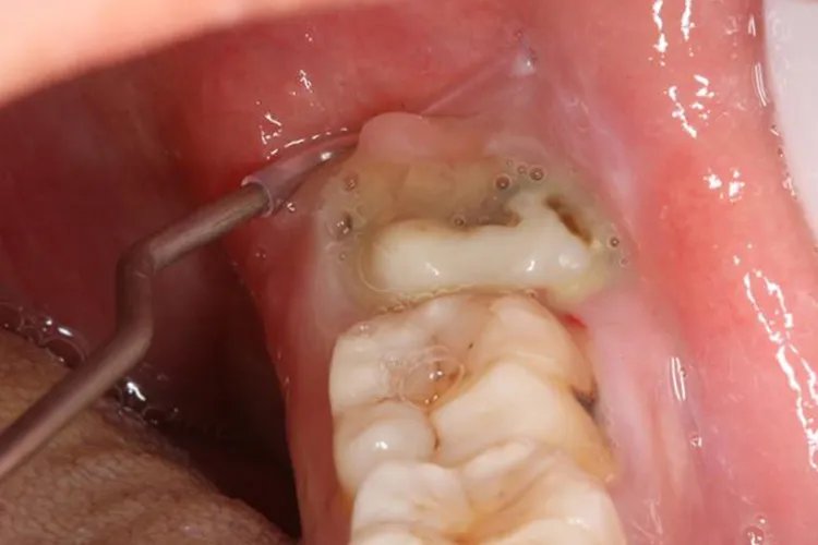 后槽牙后面的肉发白溃烂图片