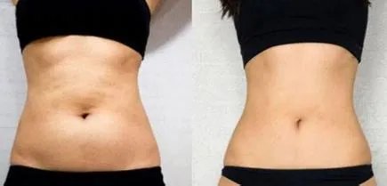 360吸脂减肥大概多少钱