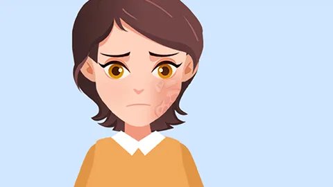 湿疹癣怎么治疗