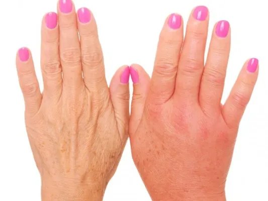 手部美白最快的方法