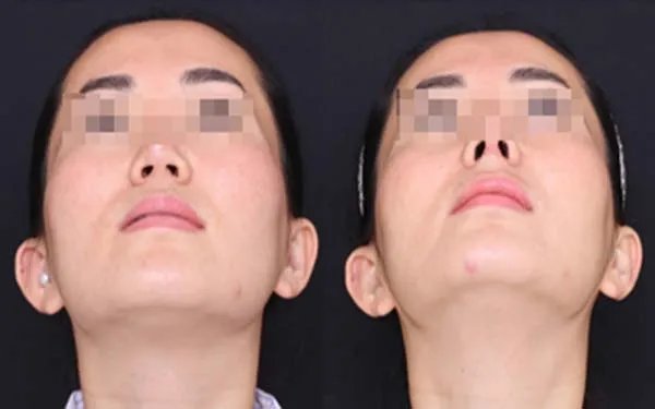 成都膨体隆鼻医院哪家好