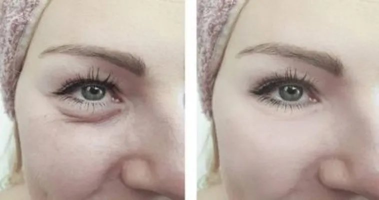 下眼睑皮肤松弛怎么治