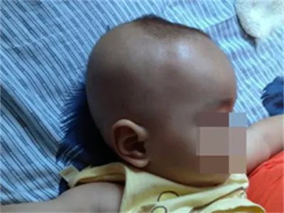 新生儿佝偻病症状图片