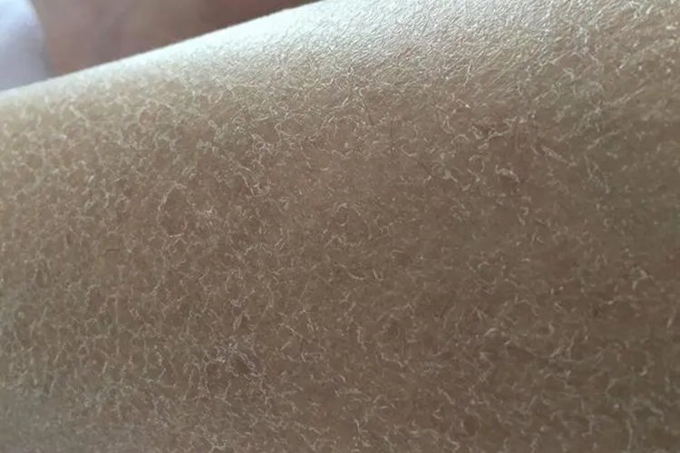 腿上有鱼鳞图片