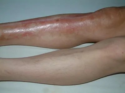 Pasini-Pierni进行性特发性皮肤萎缩红斑图片