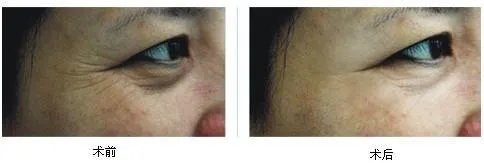 激光除皱手术一般需要多少钱