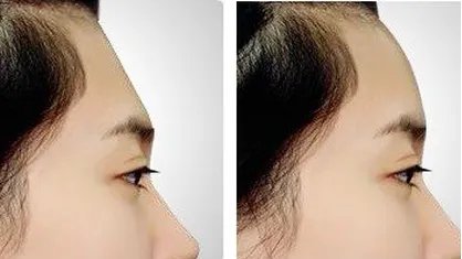 苏州做丰额头到哪个医院好？