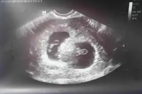 双胎胎心位置示意图