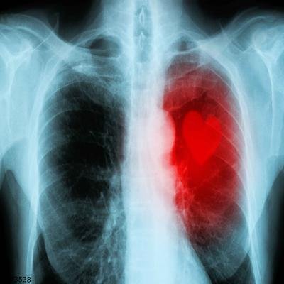 肺癌伴骨转移晚期症状有哪些