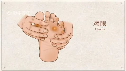 鸡眼怎样根治