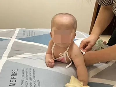 新生儿佝偻病症状图片