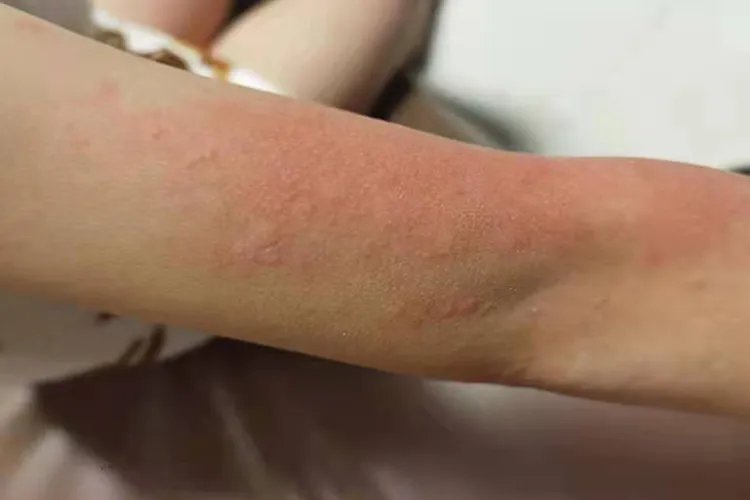皮麻疹是什么症状图片
