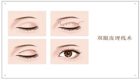 割双眼皮哪里好