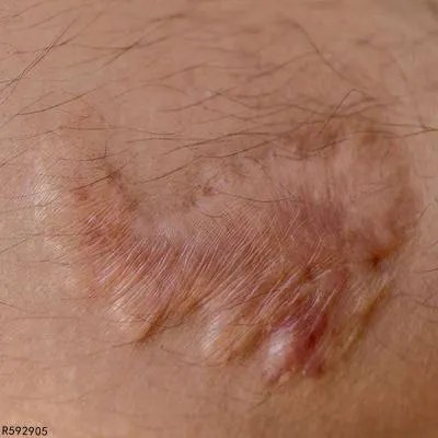 开水烫疤怎么去除