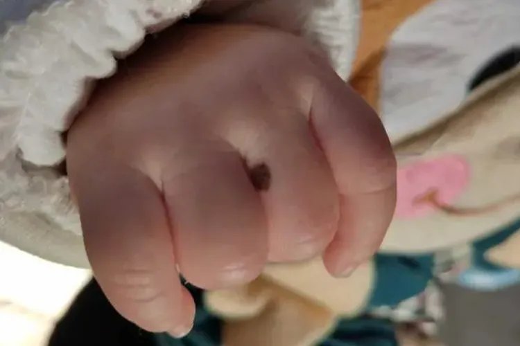 孩子手指上突然长痣图片