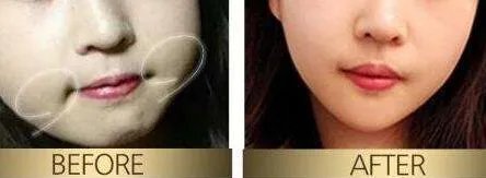 去颊脂垫有副作用吗