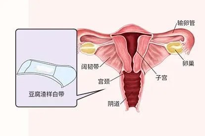 霉菌性阴炎的主要症状图片
