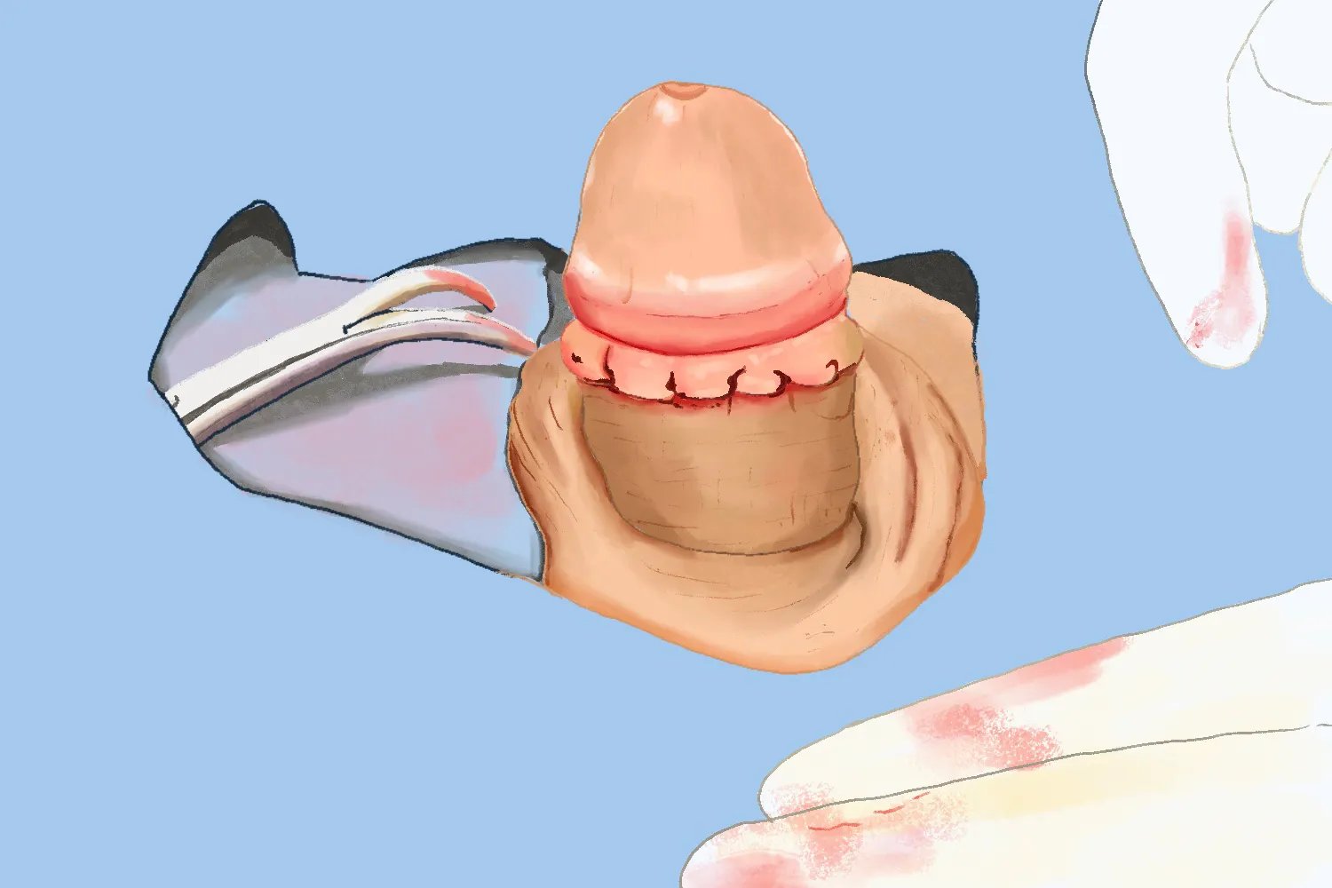 做完包茎手术后的样子图片