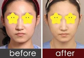 注射botox后注意事项