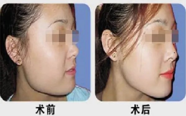 磨骨瘦脸整形前后惊人对比图