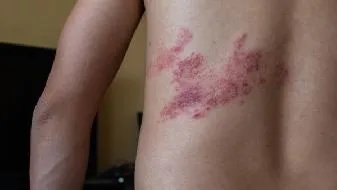 男性肝癌的早期症状主要有什么?