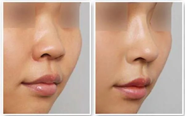 北京整形医院哪家做隆鼻好?