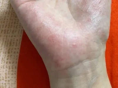 手部湿疹手掌水疱图片