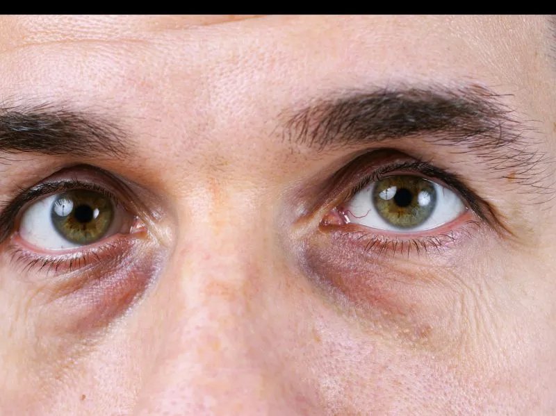 出现黑眼袋怎么办