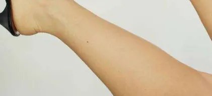 小腿吸脂手术如何