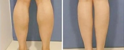 注射botox瘦腿费用