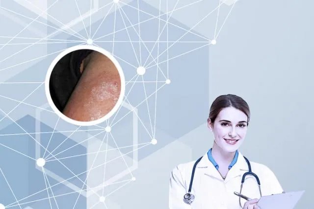 牛皮癣有偏方大全