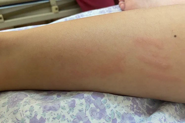 皮麻疹是什么症状图片