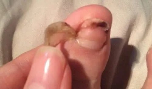 小伙脚趾莫名脱落：为什么会脱落患有什么病详情