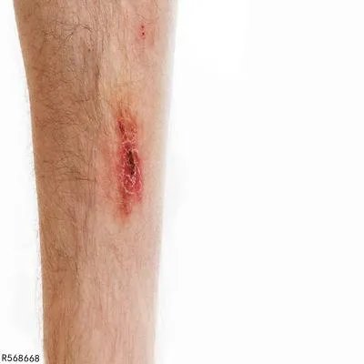 撞到小腿肿了怎么办