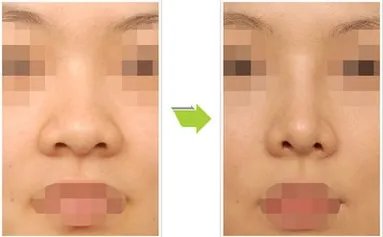 假体隆鼻前后对比照