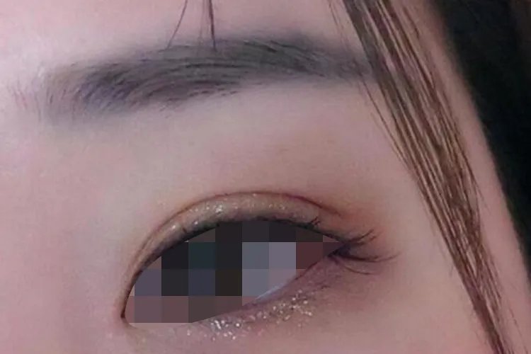 双眼皮类型及图片大全