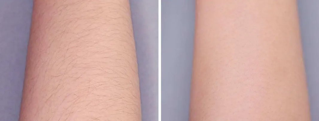 脸部永久脱毛要多少钱