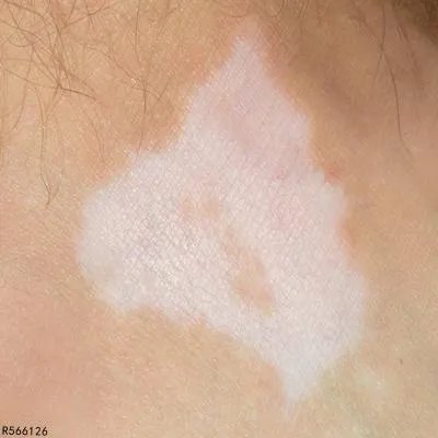 白癜风是由什么原因引起的