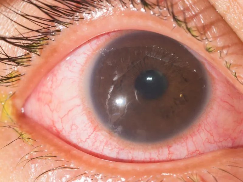 复方门冬泛甘滴眼液使用注意事项