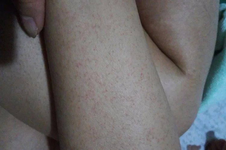 白血病小红点特征图