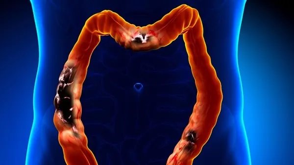 吃3年酵素大肠表面宛若蛇皮 这样治疗便秘可不靠谱 