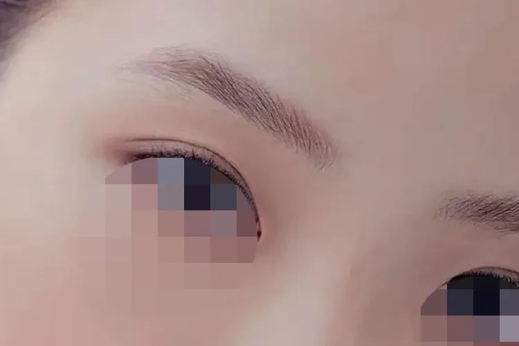 双眼皮类型及图片大全