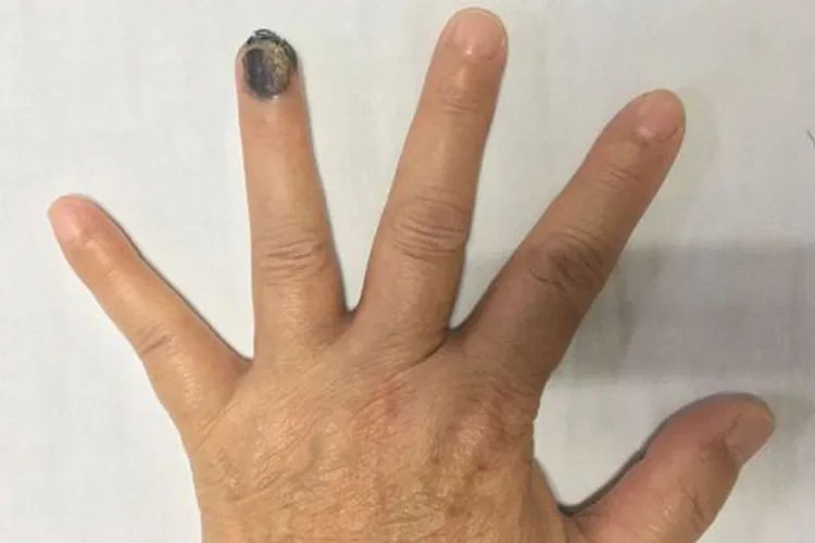 手指上黑点是癌症信号图片